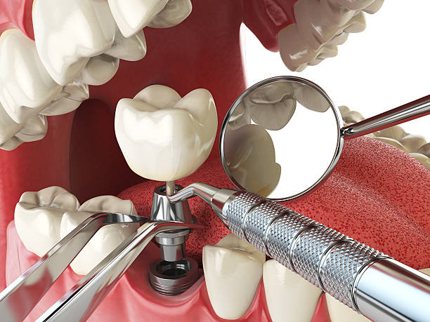 Best Emergency Cosmetic Dentistry (e.g., broken veneers) in New Lno, LA